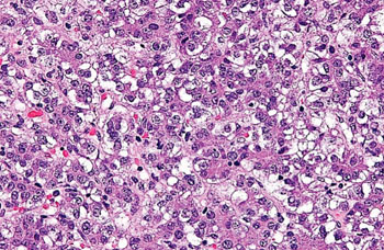 Image: Histopathology of a hepatoblastoma, a type of liver cancer found in infants and young children (Photo courtesy of Nephron).