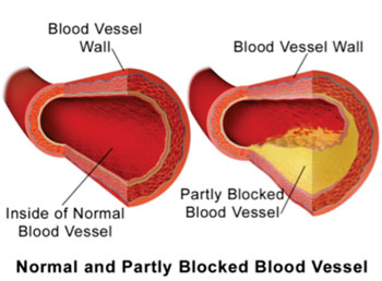 Image: Illustration comparing a normal blood vessel and partially blocked vessel due to atherosclerotic plaque build-up (Photo courtesy of Wikimedia Commons).