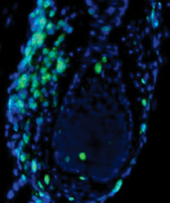 Image: Hair follicle (blue) being attacked by T cells (green) (Photo courtesy of Christiano Lab/Columbia University Medical Center).
