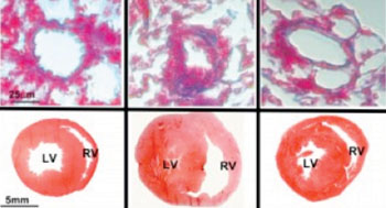 Image: Differences in the structure of a small lung artery (top row) and heart (lower row) of rodents without disease (far left column); with pulmonary hypertension (middle) and a diseased rodent treated with the molecule microRNA193 (right). Note the much narrowed lung artery, and thick walls and larger chamber of the heart in the diseased animal and improvements with microRNA-193 treatment (Photo courtesy of UCLA - University of California, Los Angeles).