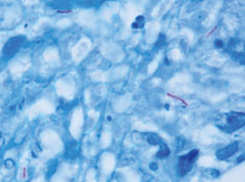 Image: M. tuberculosis (stained red) in tissue (blue) (Photo courtesy of Wikimedia Commons).
