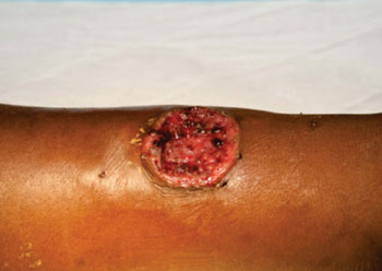 Image: A primary yaws skin lesion on an infant patient’s leg (Photo courtesy of Dr. Oriol Mitjá).