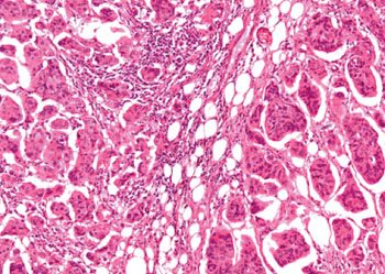 Image: Histopathology of Breast Adenocarcinoma, × 20 magnification (Photo courtesy of Nikon).