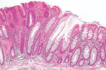 Image: Histopathology of a colorectal tubular adenoma without high grade dysplasia (Photo courtesy of Nephron).