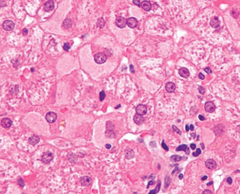 Image: Photomicrograph from a liver biopsy showing ground glass hepatocytes, as seen in a chronic hepatitis B infection with a high viral load (Photo courtesy of Nephron).