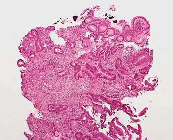 Image: Histopathology of non-polyposis colorectal cancer or Lynch Syndrome (Photo courtesy of Dr. L. Marcucci MD).