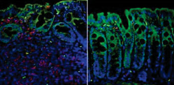 Inflammatory response and damage to the intenstinal wall (left) could be prevented by injecting TRPV1-deficient T-cells (right). Photo courtesy of Nature Immunulogy, Bertin et al.).