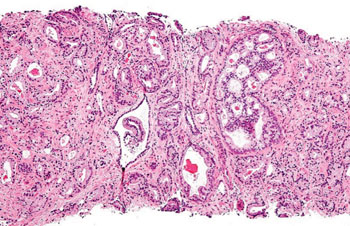 Image: Histopathology of prostatic acinar adenocarcinoma, the most common form of prostate cancer, Gleason pattern 4, from prostate curettings (Photo courtesy of Nephron).