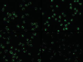 Image: Immunofluorescence staining pattern of ANCA using FITC conjugate demonstrates presence of antineutrophil cytoplasmic antibodies (ANCA). Top left - PR3 antibodies on ethanol-fixed neutrophils showing a cytoplasmic ANCA pattern. Bottom left - PR3 antibodies on formalin-fixed neutrophils showing a cytoplasmic ANCA pattern. Top right - MPO antibodies on ethanol-fixed neutrophils showing a perinuclear ANCA pattern. Bottom right - MPO antibodies on formalin-fixed neutrophils showing a cytoplasmic ANCA pattern (Photo courtesy of  Wikimedia Commons).