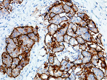 Image: Immunohistochemical staining of ovarian tissue with anti-CA125 for the diagnosis of ovarian carcinoma; the neoplastic cells are strongly stained (Photo courtesy of Epitomics).
