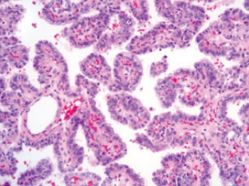 Image: Classical type papillary thyroid carcinoma (Photo courtesy of University of Michigan Comprehensive Cancer Center).