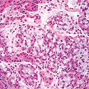 Image: Histopathology of pulmonary adenocarcinoma with prominent signet-ring cell features (Photo courtesy of Cesar A. Moran, MD).