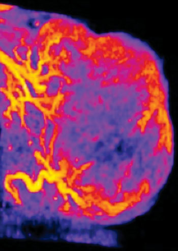 Image: An intensity-colored image of blood flow in a PECAM1-positive tumor (Photo courtesy of the University of North Carolina School of Medicine).