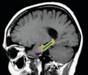 Image: This fMRI scan shows the brain area outlined in yellow is the hippocampus; the dentate gyrus is shown in green and the entorhinal cortex in purple. Previous work, including by the laboratory of senior author Scott A. Small, M.D., had shown that changes in a specific part of the brain’s hippocampus--the dentate gyrus--are associated with normal age-related memory decline in humans and other mammals. The dentate gyrus is distinct from the entorhinal cortex, the hippocampal region affected in early-stage Alzheimer’s disease (Photo courtesy of the Laboratory of Scott A. Small, MD).