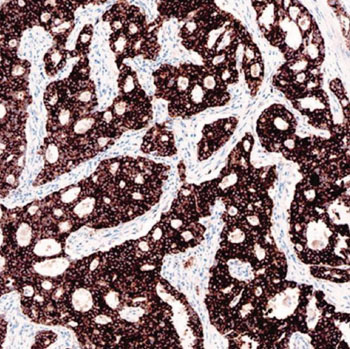 Image: Immunohistochemistry of lung tissue positive for anaplastic lymphoma kinase in non-small-cell lung cancer (Photo courtesy of Ventana Medical Systems).
