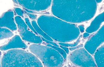 Image: Micrograph of a muscle biopsy from a patient with amyotrophic lateral sclerosis demonstrating the typical \"grouped atrophy\" of muscle fibers that occurs with denervation (Photo courtesy of the University of Utah).