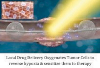 Image: Local drug delivery oxygenates tumor cells to reverse hypoxia and sensitizes them to therapy (Photo courtesy of Sanovas).