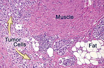 Image: Histopathology of a bladder with infiltrating high grade urothelial carcinoma, seen in muscle and fat (Photo courtesy of Johns Hopkins Pathology).