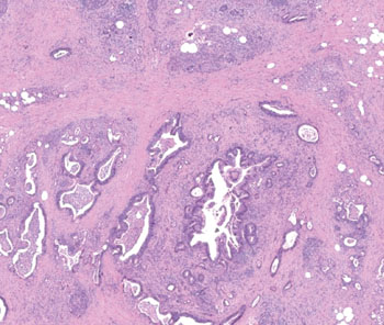 Image: Histopathology of invasive pancreatic ductal adenocarcinoma (Photo courtesy of Casemed2013).