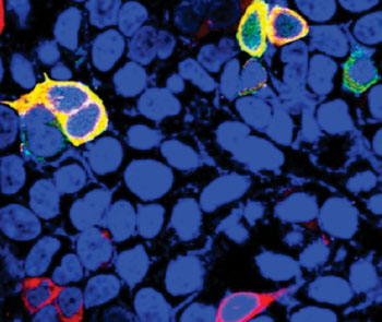 Image: The Sestrin 3 protein, labeled in red fluorescence and shown interacting with other proteins (highlighted in yellow) in the liver, may have implications in treating type II diabetes (Photo courtesy of the Indiana University School of Medicine).