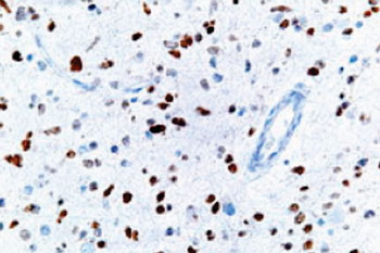 Image: A micrograph showing cells with abnormal P53 expression (brown) in a brain tumor (Photo courtesy of Wikimedia Commons).