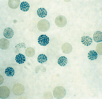 Image: Inclusion body positive cells seen in Brilliant Cresyl Blue stained red cells of a α0-thalassaemia carrier (Photo courtesy of American Society of Hematology).