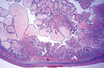 Image: Histopathology of ovarian serous papillary borderline tumor, intracystic, without surface cortical involvement (Photo courtesy of Brown University).