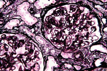 Image:  Very high magnification micrograph of membranous nephropathy (also membranous glomerulonephritis). Jones stain of kidney biopsy. The characteristic feature on light microscopy is basement membrane thickening/spike formation (best seen with silver stains). On electron microscopy, subepithelial deposits are also seen (Photo by Nephron, courtesy of Wikimedia).
