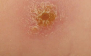 Image: Cutaneous leishmaniasis facial lesion, prior to initiation of successful treatment with daylight-activated photodynamic therapy (DA-PDT) (Photo courtesy of Enk CD et al. 2014, and the British Journal of Dermatology).