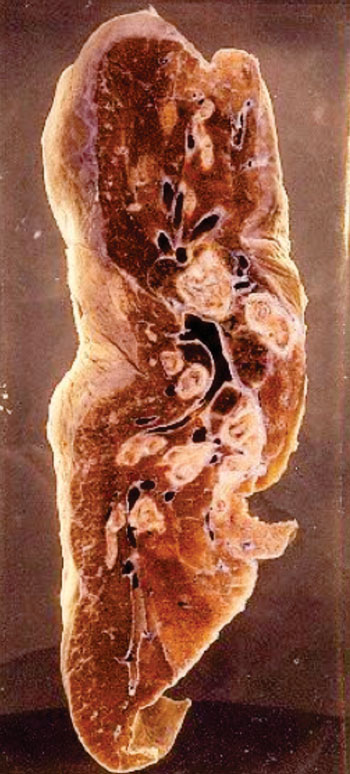 Image: Gross pathology of a cross section of a lung from an asthmatic with obstruction of major airways or bronchi (Photo courtesy of the University of New South Wales).