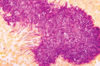 Image: Histopathological appearance of Black Grain Eumycetoma caused by Madurella mycetomatis (Photo courtesy of Dr. Libero Ajello).