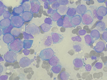 Image: Bone marrow aspirate showing acute myeloid leukemia (Photo courtesy of Wikimedia Commons).
