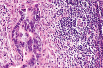 Image: Micrograph of lymph node with colorectal carcinoma (Photo courtesy of Wikimedia Commons).