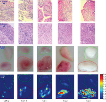 Image: Comparison of between normal cervical tissue (top), tissue lesion (second row), photographic image (third row) and corresponding DMAP images (fourth row) (Photo courtesy of Biomedical Optics Express).