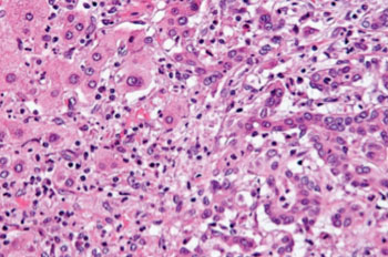 Image: Micrograph of an intrahepatic cholangiocarcinoma (right of image) adjacent to benign hepatocytes (left of image) (Photo courtesy of Wikimedia Commons).