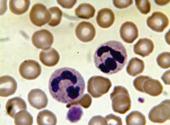 Image: Photomicrograph of a peripheral blood smear stained with Leishman (Photo courtesy of Quazoo).