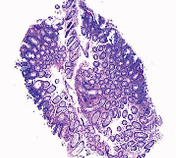 Image: Biopsy slide of a classic tubular adenoma polyp that is precancerous (Photo courtesy of Dr. Scot M. Lewey).