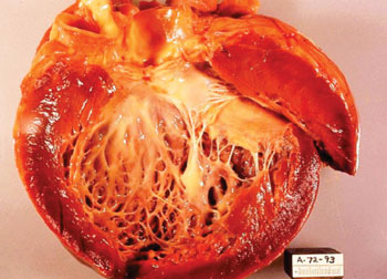 Image: Gross pathology of idiopathic cardiomyopathy. Opened left ventricle of heart shows a thickened, dilated left ventricle with subendocardial fibrosis manifested as increased whiteness of endocardium at autopsy (Photo courtesy of Dr. Edwin P. Ewing, Jr.).