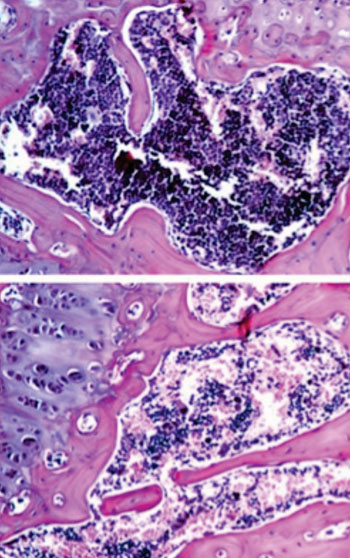 Image: The bone marrow of mice with normal ether lipid production (top) contains more white blood cells than are found in the bone marrow of mice with ether lipid deficiency (bottom) (Photo courtesy of Washington University School of Medicine).