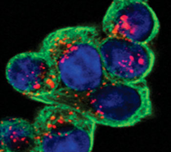Image: Cancer cells infected with tumor-targeted oncolytic virus (red). Green indicates alpha-tubulin, a cell skeleton protein. Blue is DNA in the cancer cell nuclei (Photo courtesy of Dr. Rathi Gangeswaran, Bart’s Cancer Institute).