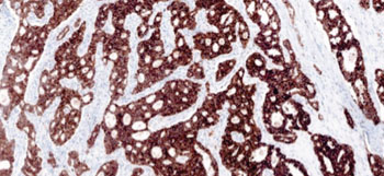 Image: Positive case of lung tissue stained for ALK with VENTANA ALK (D5F3) CDx Assay, a companion diagnostic immunohistochemical test in the final stages of the FDA premarket approval process (Photo courtesy of Ventana Medical Systems and PRNewsFoto).