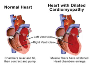 Image: Illustration of a normal heart compared to a heart with dilated cardiomyopathy (Photo courtesy of Blausen Gallery 2014. Wikiversity Journal of Medicine).