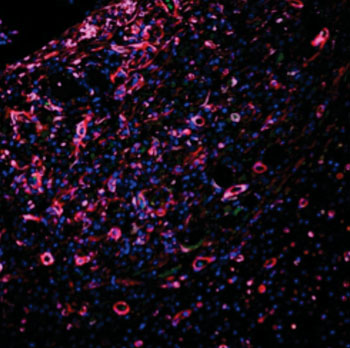Image: The micrograph shows the extensive infiltration of robust blood vessels (red) in a new hydrogel scaffold developed to help the healing of internal injuries. The purple cells are pericyte-like cells that surround new endothelial cells, helping to stabilize the vessels. The green cells are circulating through the new vascular system (Photo courtesy of Dr. Vivek Kumar, Rice University).