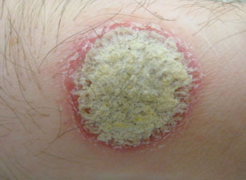 Image: A psoriatic plaque, showing a silvery center surrounded by a reddened border (Photo courtesy of Dr. James Heilman).