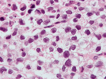 Image: Micrograph of a testicular seminoma with histologic characteristics of a seminoma, clear cytoplasm with a central nucleus (‘fried egg-like cells’) (Photo courtesy of Nephron).