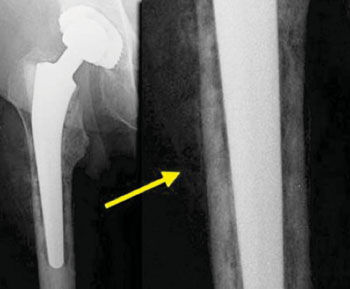 Image: On the left are the typical radiographic findings of infection with irregular bone destruction and periosteal reaction. In many cases however the infection is really low grade and difficult to establish (Photo courtesy of Radiological Society of the Netherlands).