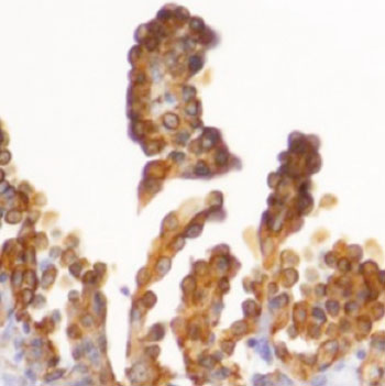 Image: Clusters of ovarian clear cell carcinoma due to mutations in the genes ARID1A and PIK3CA (Photo courtesy of Dr. Ron Chandler, University of North Carolina).