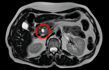 Image: Intraductal papillary mucinous neoplasm (IPMN) in magnetic resonance imaging (Photo courtesy of Wikimedia Commons).