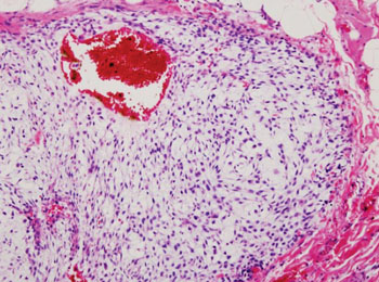 Image: Histopathology of chondrosarcoma of the chest wall from surgical resection of recurrent mass (Photo courtesy of KGH/Wikipedia).