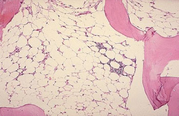 Image: Photomicrograph of a bone marrow biopsy from a patient with aplastic anemia; hematopoietic elements are markedly reduced (Photo courtesy of the University of Utah).